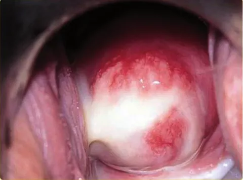 Chlamydia trachomatis en cervix Chlamydia trachomatis en cervix