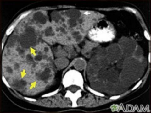 Poliquistosis renal