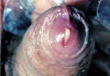 Uretritis gonocócica